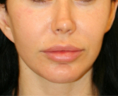 Feel Beautiful - Lip Filler Lip Lift - Before Photo